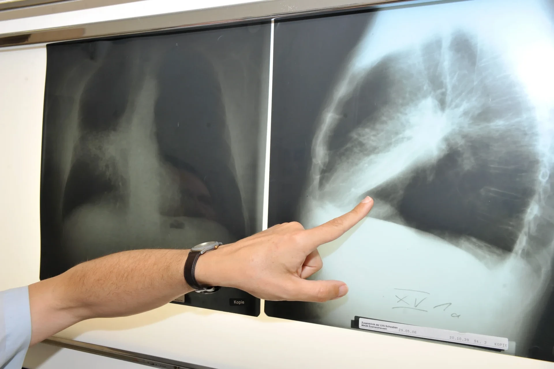 Finger zeigt auf Röntgenbild der Lunge
