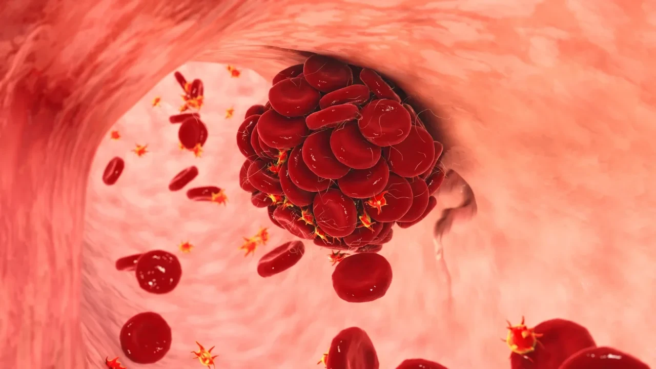 Thrombus in einem Blutgefäß: