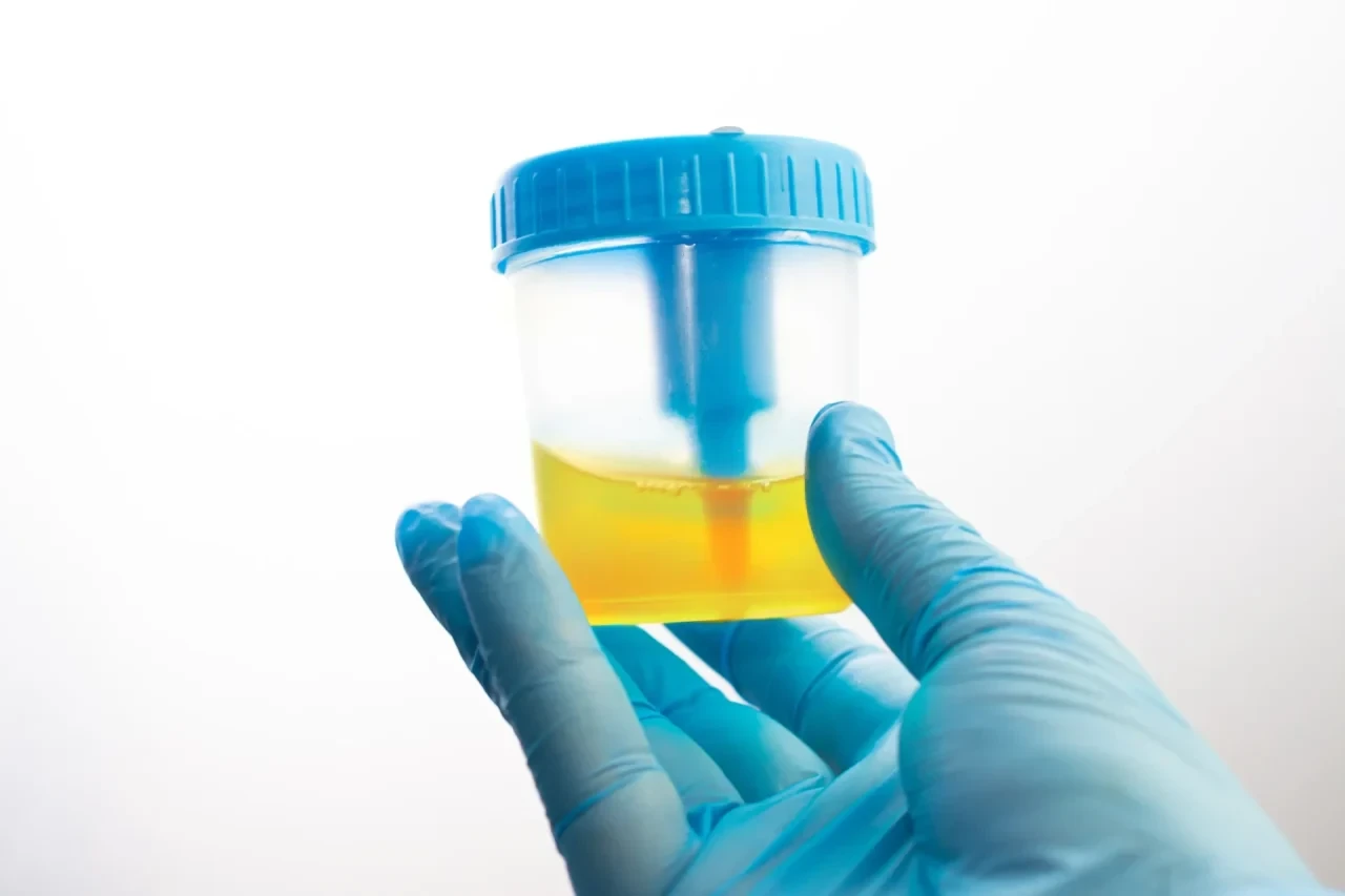 Eine blau behandschuhte Hand hält ein transparentes Probengefäß mit gelber Urinprobe vor weißem Hintergrund.