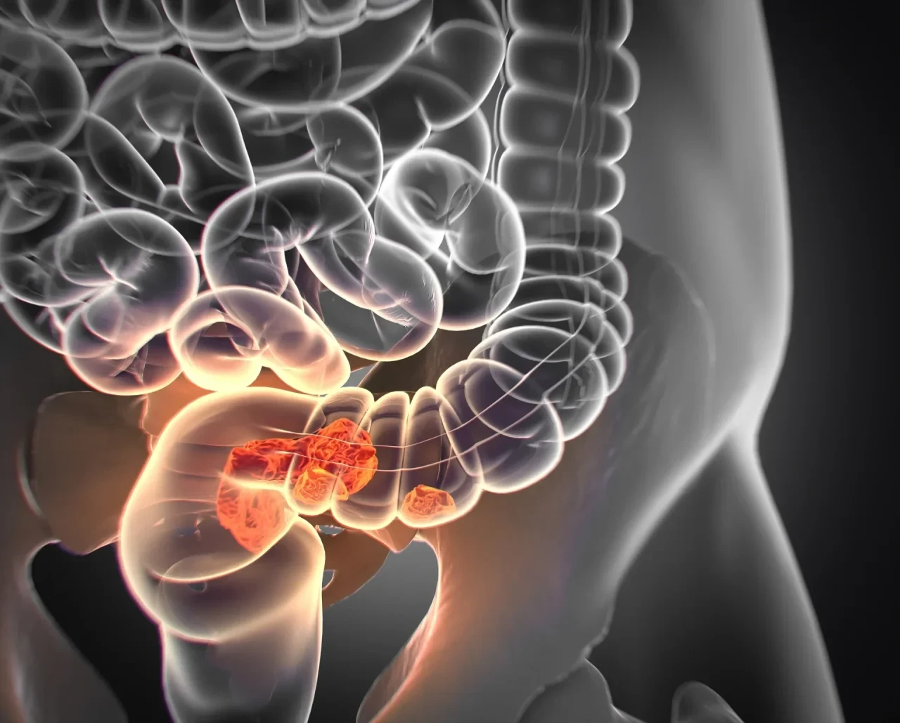 Medizinische Illustration des Darms mit einem Tumor im Dickdarm