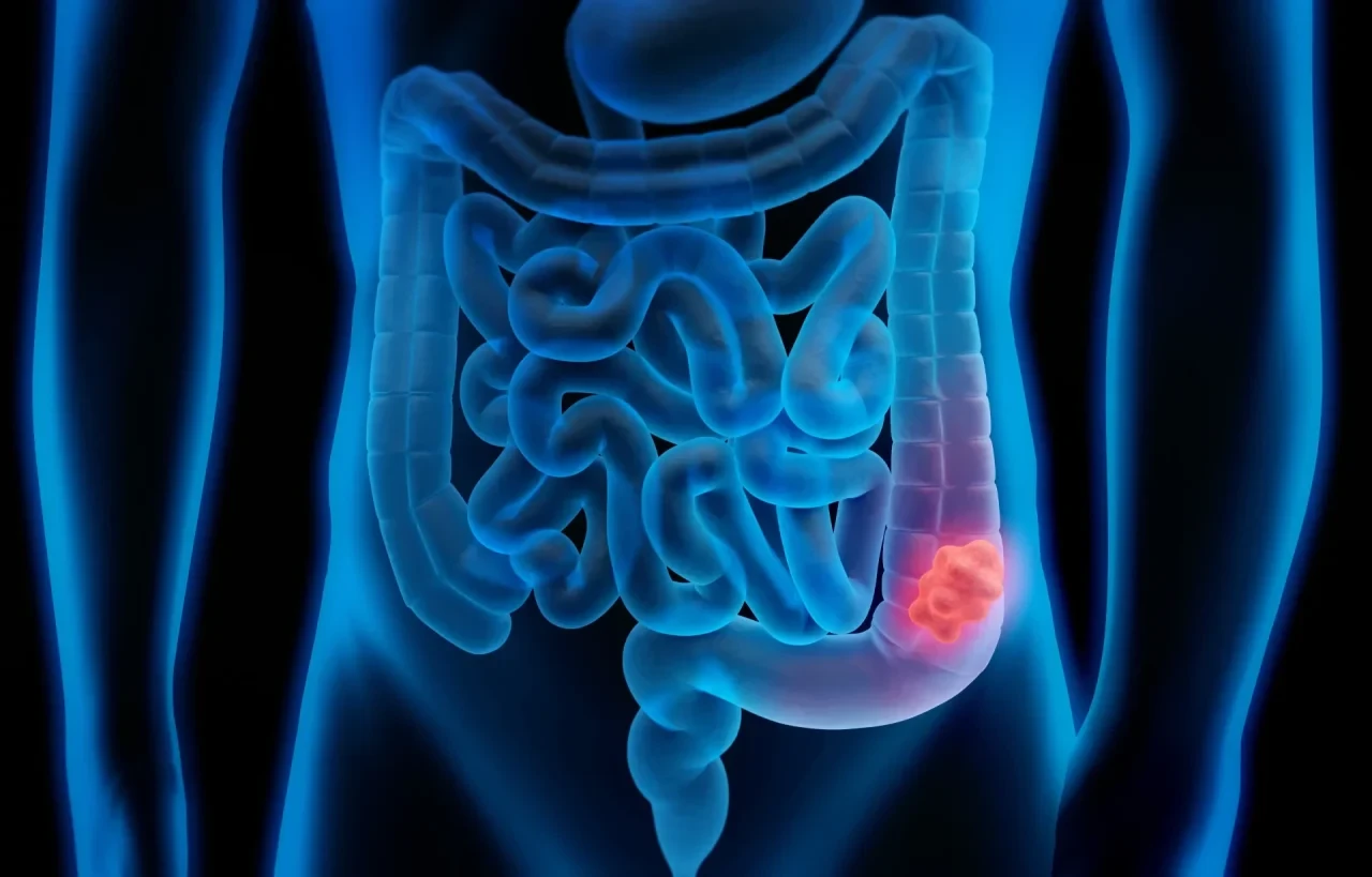 llustration des menschlichen Darms mit hervorgehobenem Tumor im Dickdarm