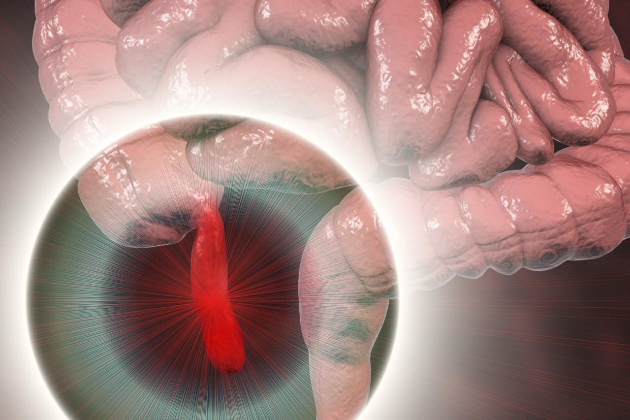 Appendizitis bei Kindern: OP statt Antibiotika