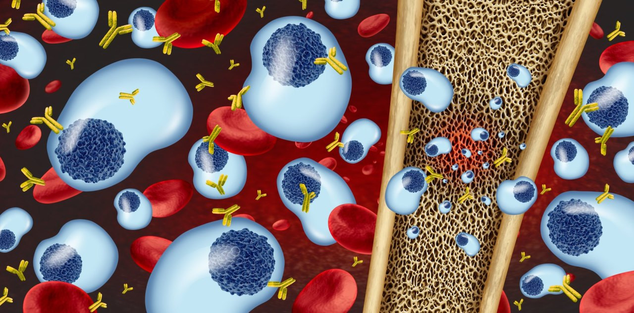 Konzept des Multiplen Myeloms und Plasmazellkrebs als Krebsgeschwür im Knochenmark mit 3D-Illustrationselementen.