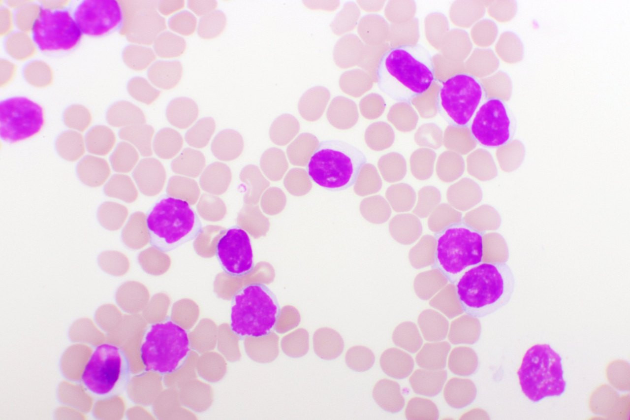 Blutbild bei chronischer lymphatischer Leukämie (CLL), mikroskopisch analysiert, Originalvergrößerung 1000-fach