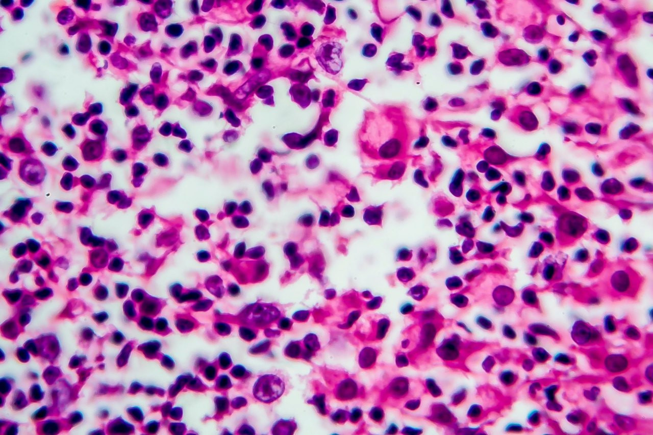 Histologischer Mikroskopieschnitt eines Hodgkin-Lymphoms mit zahlreichen Tumor- und Entzündungszellen in violett-rosa Färbung.