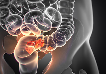 Anatomische Darstellung eines Kolontumors: