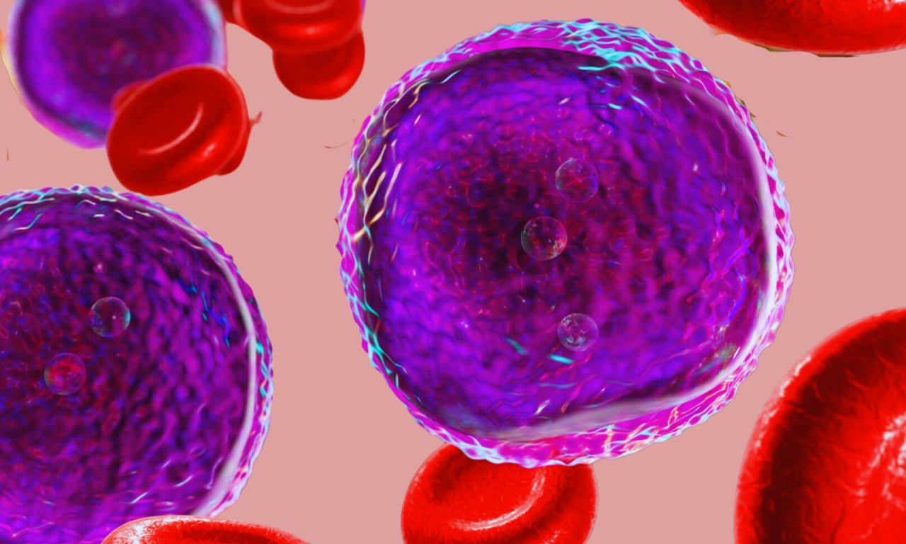 Akute lymphoblastische Leukämie - Krebszellen und Erythrozyten