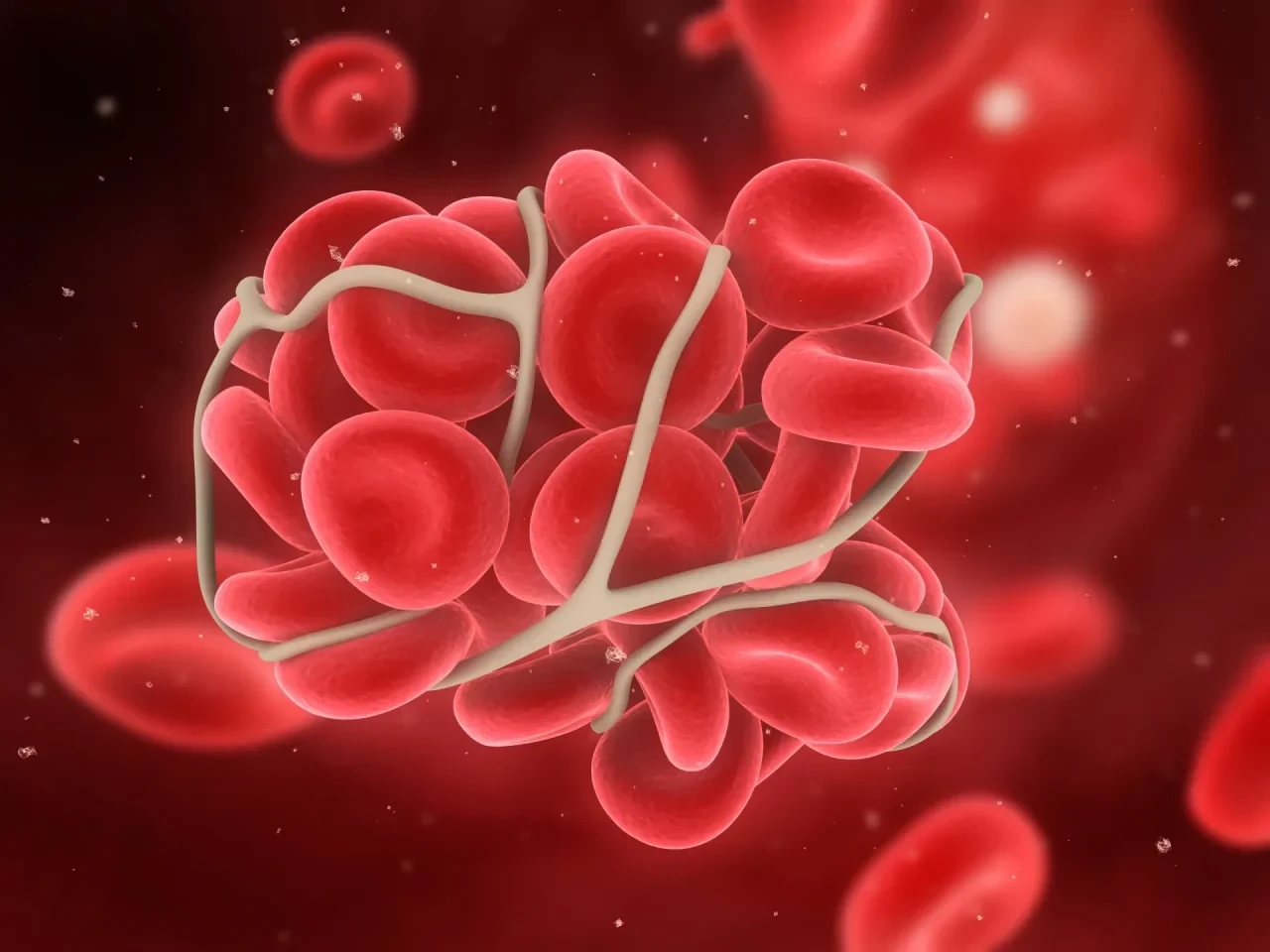 Blutgerinnsel Thrombus im Gefäß