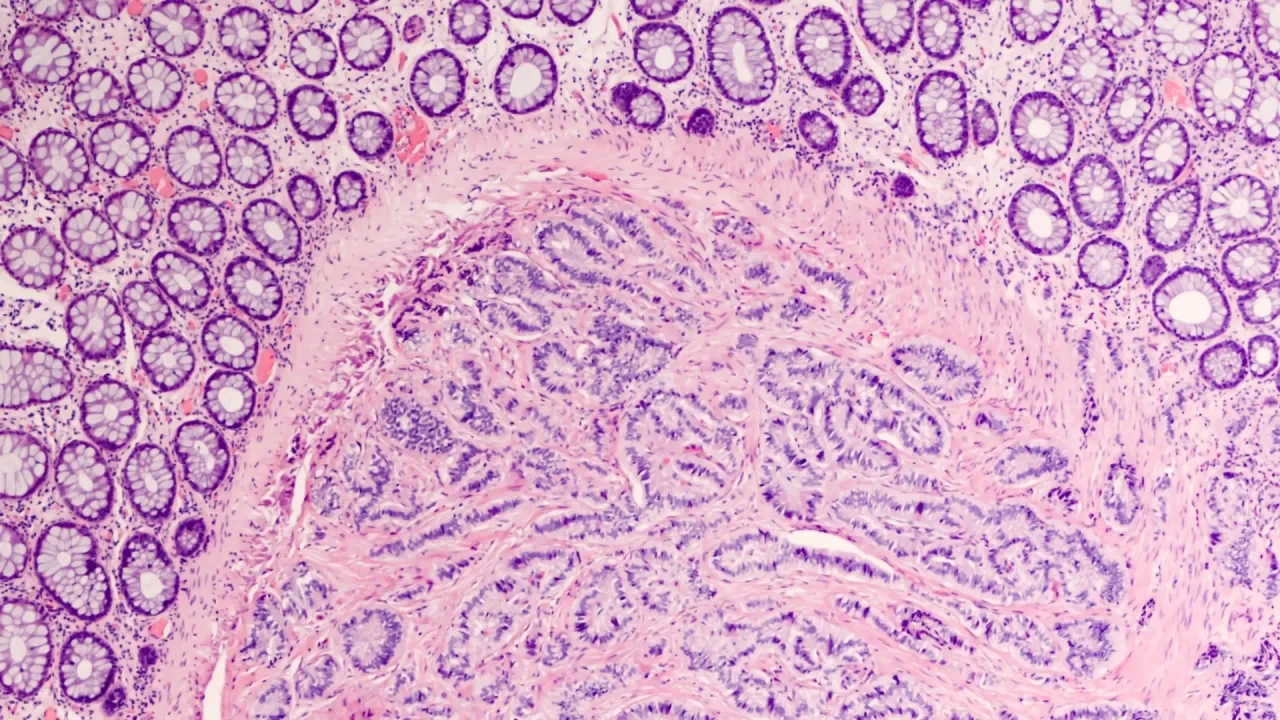 Histologisches Bild eines neuroendokrinen Tumors aus einem Dünndarmpolypen