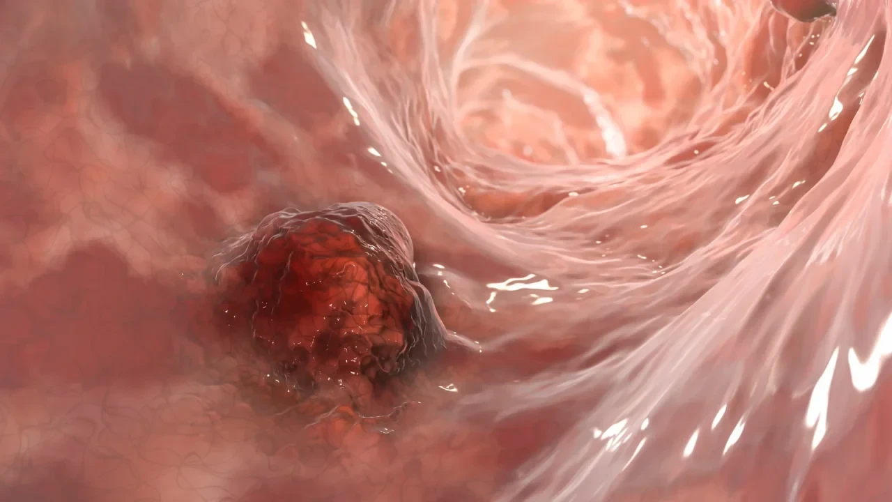Darmkrebs, Darmkarzinom, Darmneoplasie, 3D-Darstellung eines bösartigen Tumors im Darm