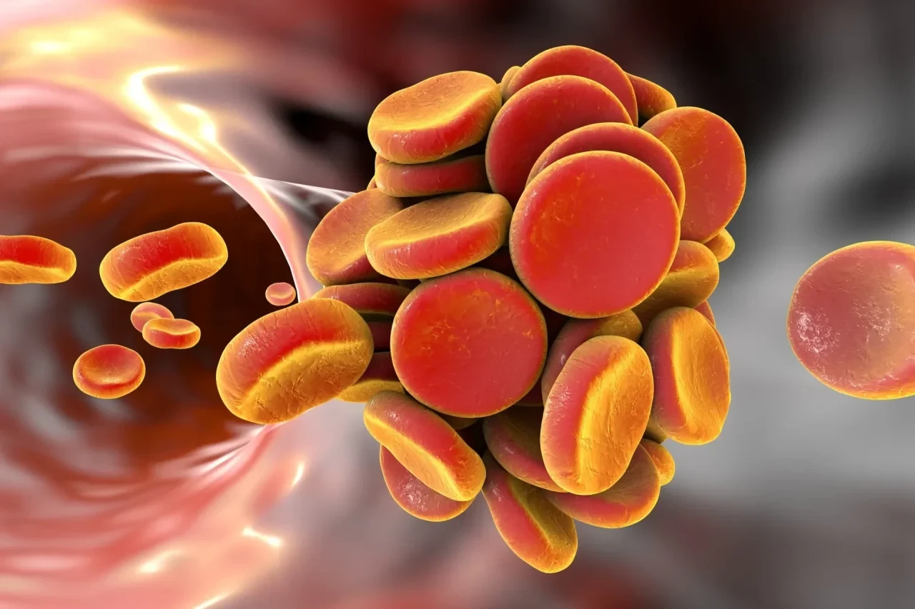 Thrombose