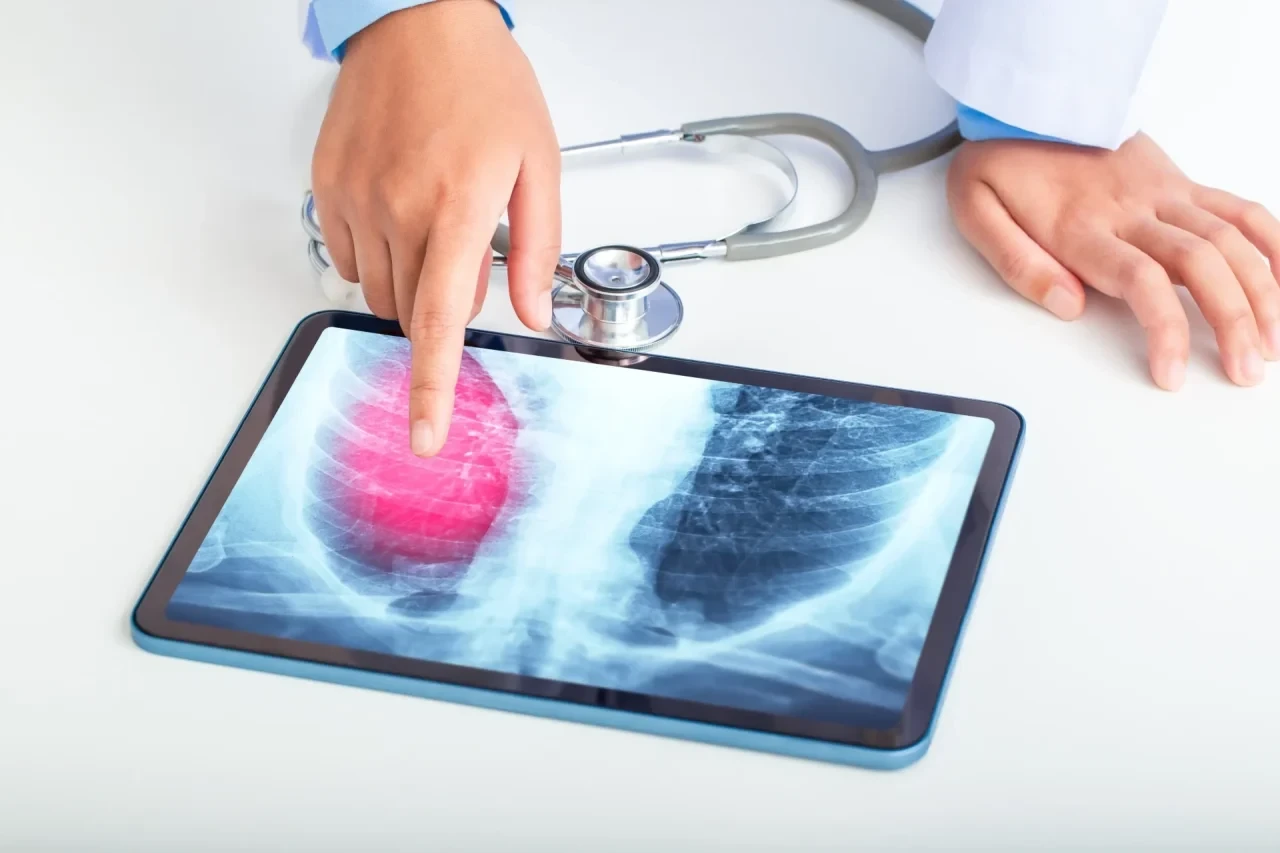 Eine medizinische Fachperson zeigt mit einem Finger auf eine Röntgenaufnahme des Brustkorbs auf einem Tablet; auf der linken Lungenhälfte ist ein auffälliger, farblich hervorgehobener Bereich zu sehen, daneben liegt ein Stethoskop