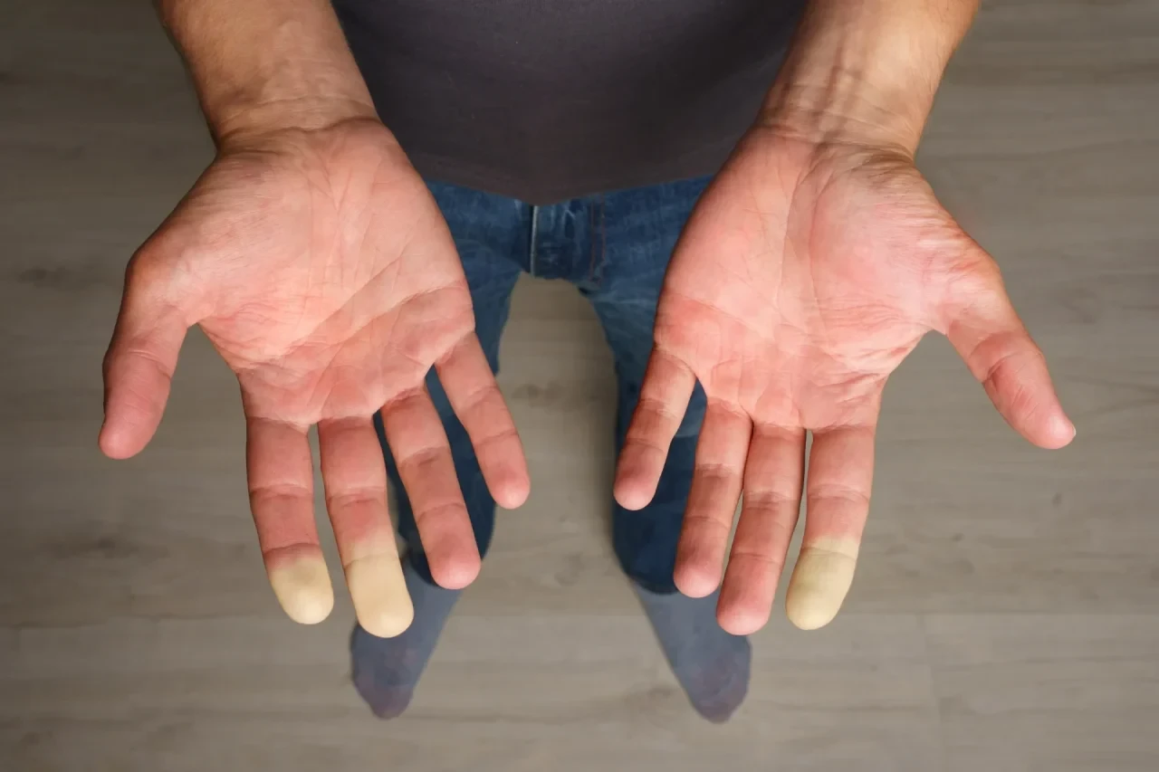Nahaufnahme von Händen mit verfärbten Fingern als Zeichen eines Raynaud-Syndroms, einem typischen Frühsymptom der systemischen Sklerose.