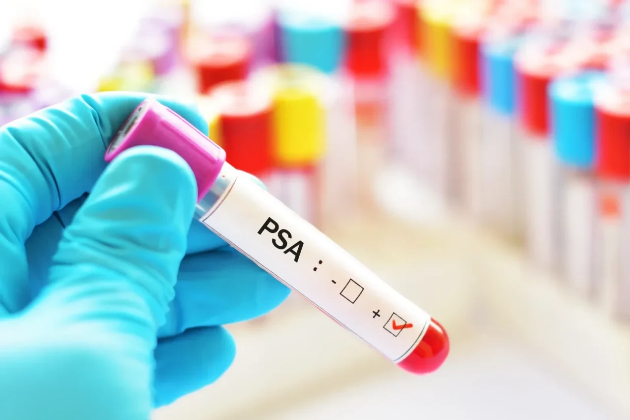 PSA-Test -