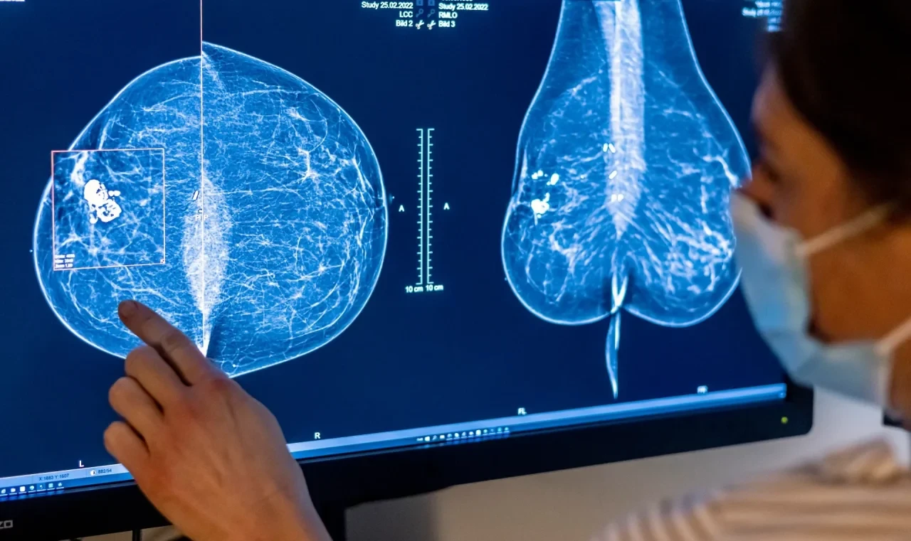 Medizinisches Personal untersucht mit einer Mammografie die Brust einer Frau auf Brustkrebs.