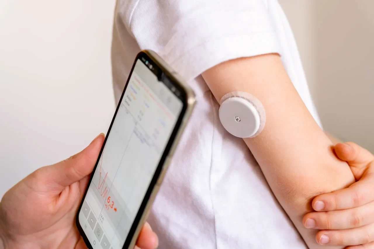 Eine Person mit Diabetes betrachtet auf einem Smartphone die Werte eines kontinuierlichen Glukosemesssystems (CGM), während ein Sensor auf dem Oberarm getragen wird.
