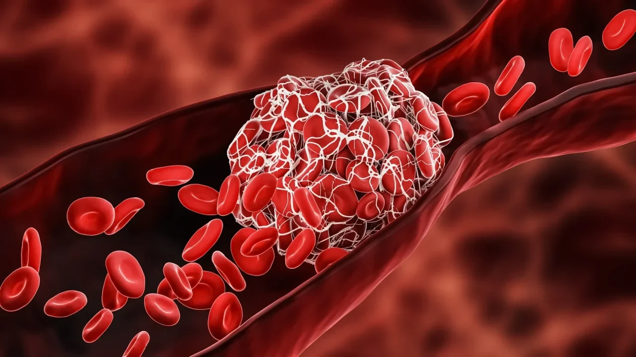 Thrombus