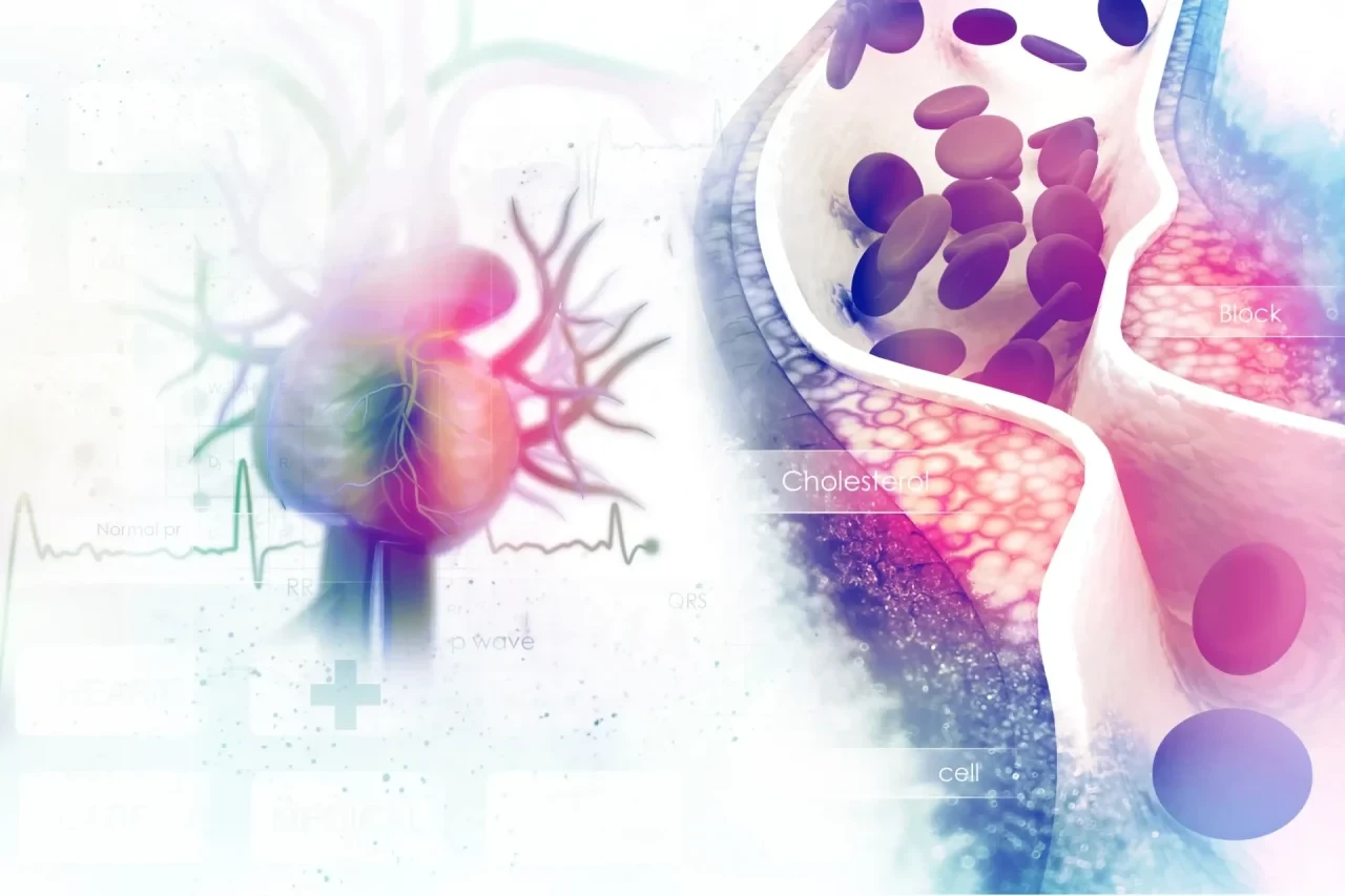Medizinische Illustration eines Herzens neben einem Längsschnitt durch eine Arterie mit Cholesterinablagerungen und verengtem Gefäßlumen