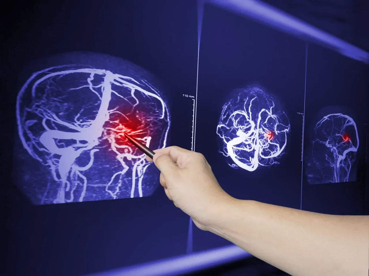 Hirnmetastasen radiologische Aufnahme