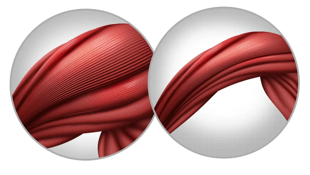 Illustration zweier roter Muskelstränge in kreisförmigen Ausschnitten auf hellem Hintergrund. Links ist ein voluminöser, kräftig ausgeprägter Muskel dargestellt, rechts ein schmalerer Muskel mit geringerem Querschnitt als Symbol für Muskelabbau beziehungsweise Muskelatrophie.