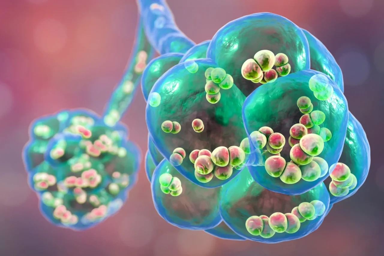Computergenerierte Darstellung von Lungenbläschen (Alveolen), die von kugelförmigen Pneumokokken-Bakterien besiedelt sind. Die Bakterien sind in den Alveolen und entlang der angrenzenden Atemwegsstrukturen sichtbar.