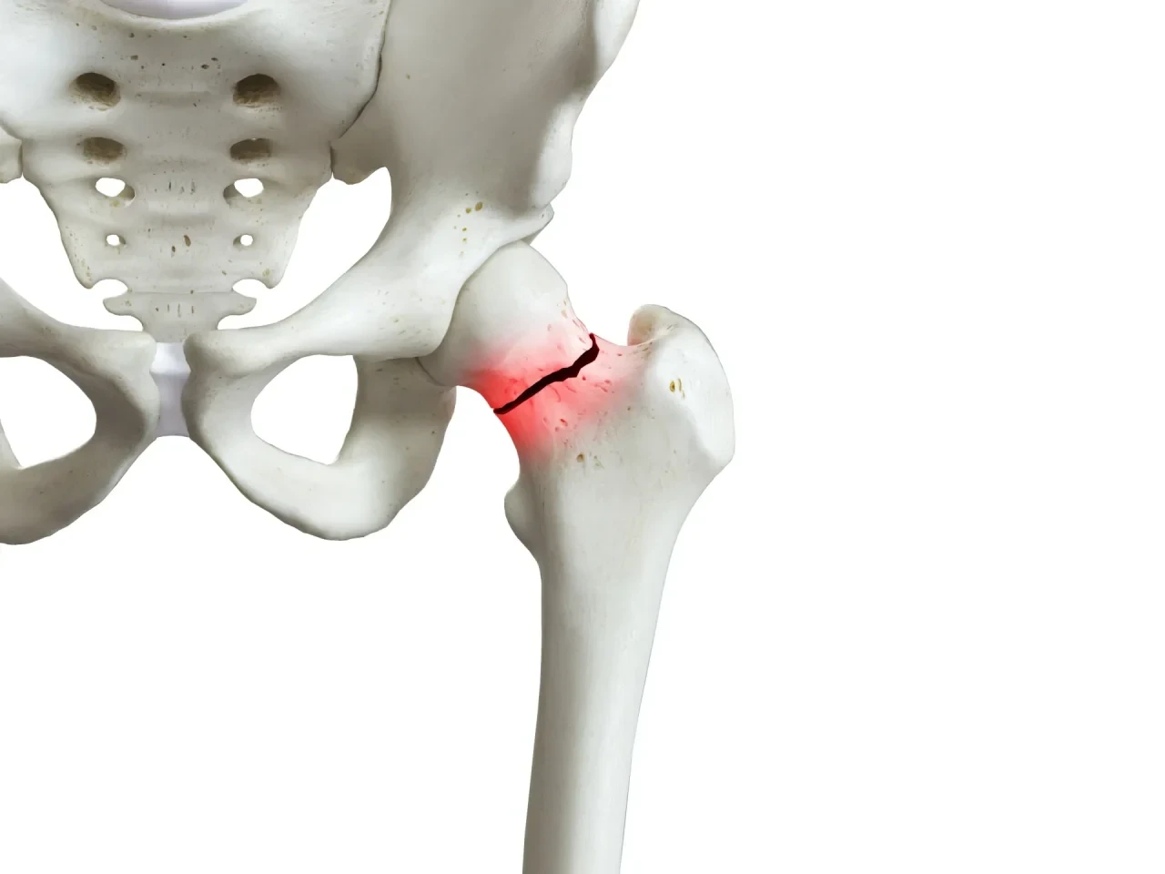 Anatomische Darstellung des Beckens und des proximalen Oberschenkelknochens mit einem Bruch im Bereich des Oberschenkelhalses. Die Frakturstelle ist rot hervorgehoben.