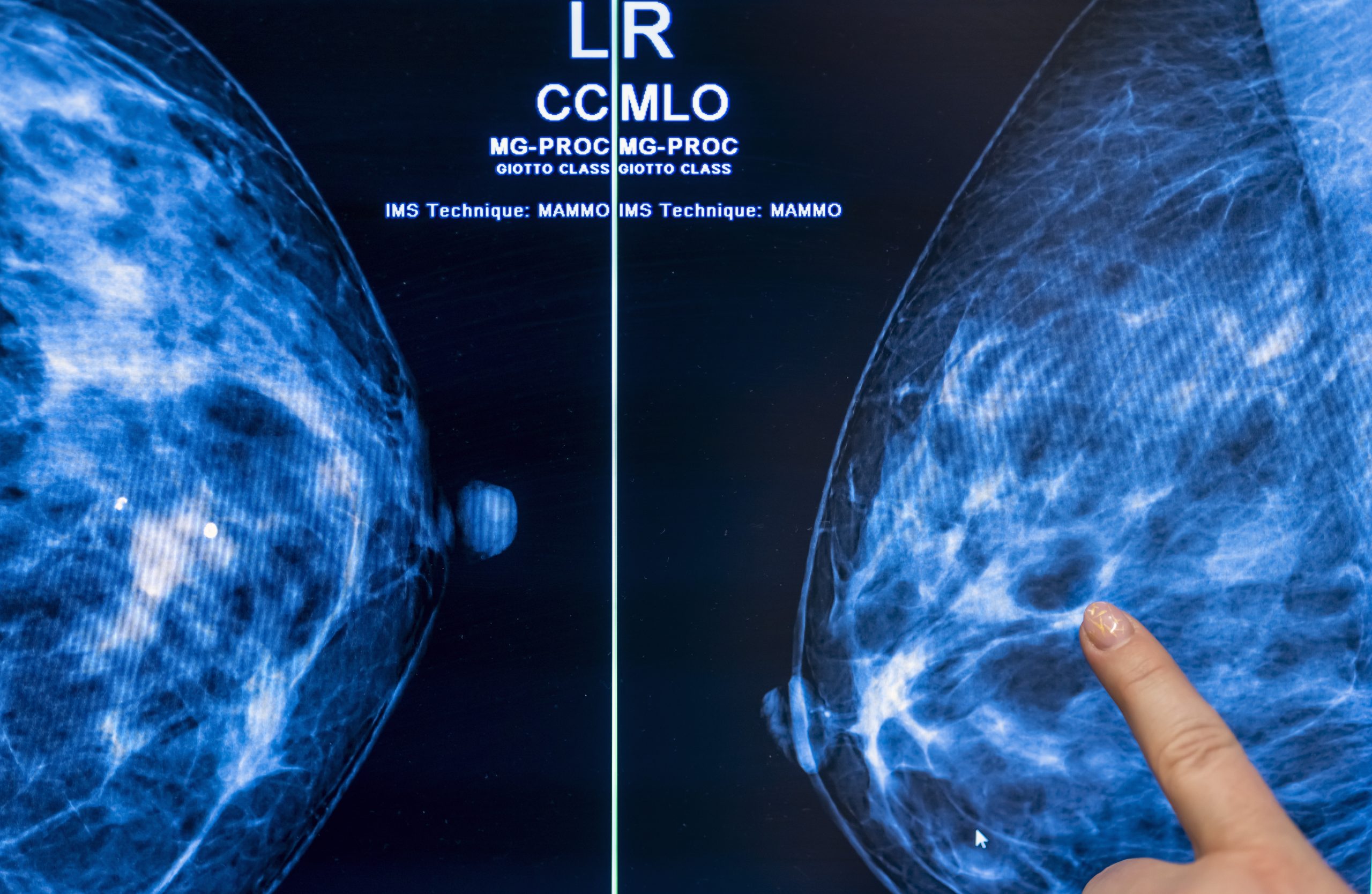 Mammografie-Screening senkt Brustkrebs-Sterblichkeit