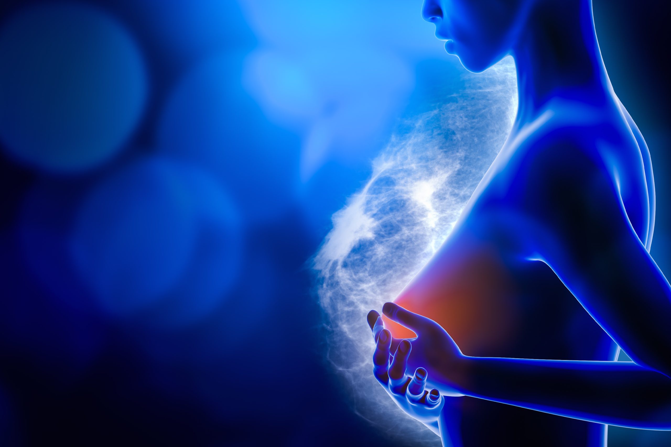 Mammakarzinom: ctDNA zeigt Metastasierungsrisiko früh